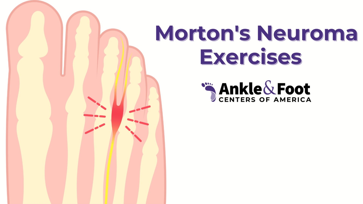 Morton S Neuroma Exercises Say No To Surgery