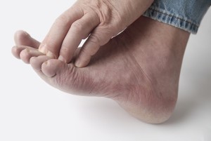 Area of the Foot Where Corns Form