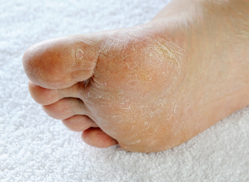 diabetic dry feet cracked