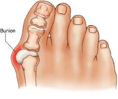 Bunion Surgery – Foot and Ankle Doctors in Snellville, Georgia Provide Treatment