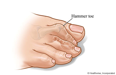 hammer-toe