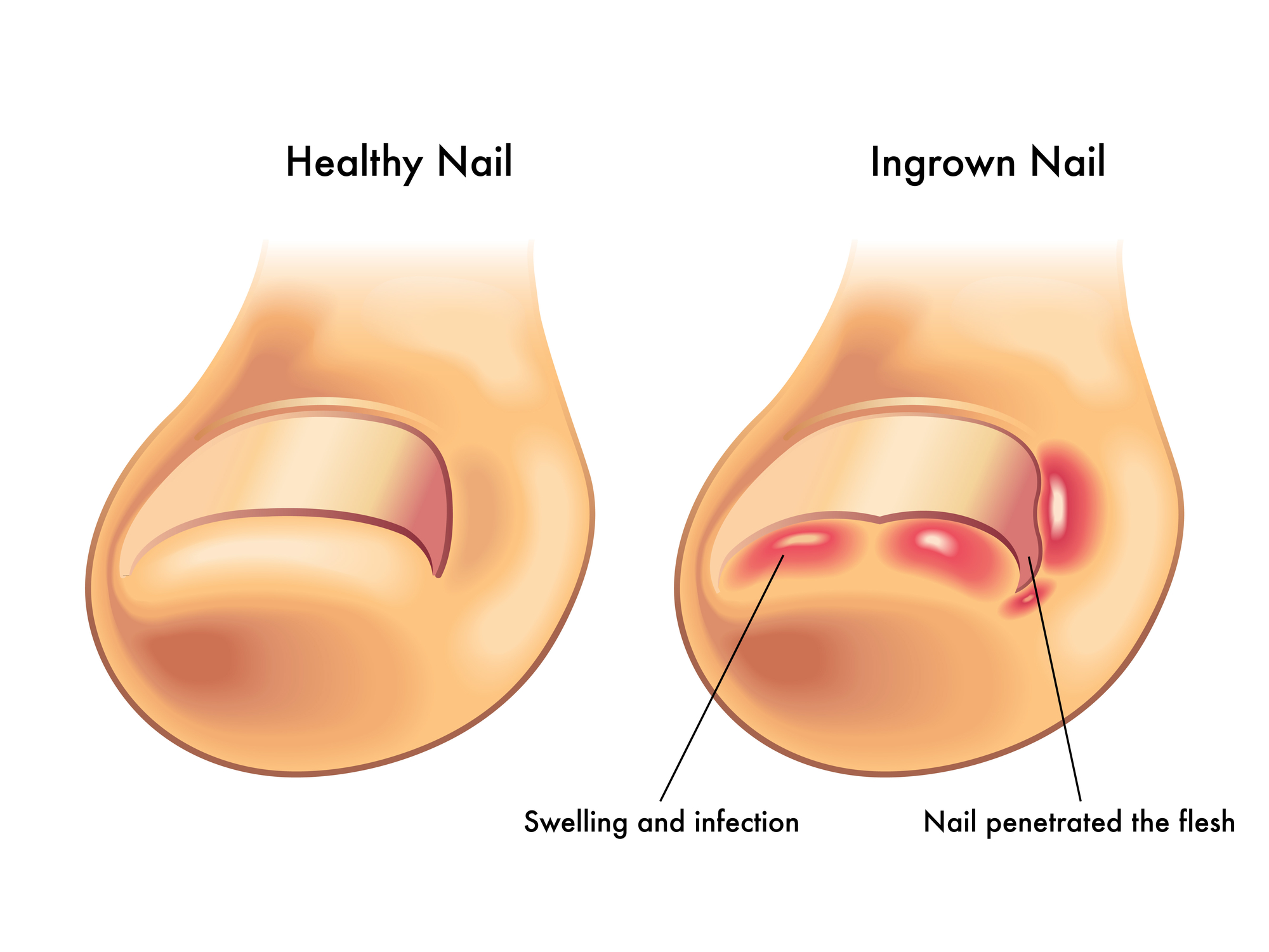 Ingrown toenails — Haag Foot & Ankle