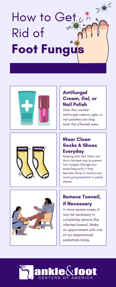 How To Get Rid of Foot Fungus