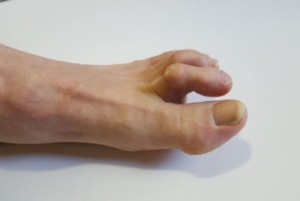 How to Correct a Hammertoe Without Surgery