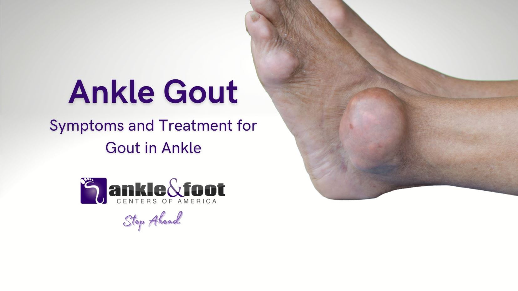 Ankle Gout - Symptoms and Treatment for Gout in Ankle