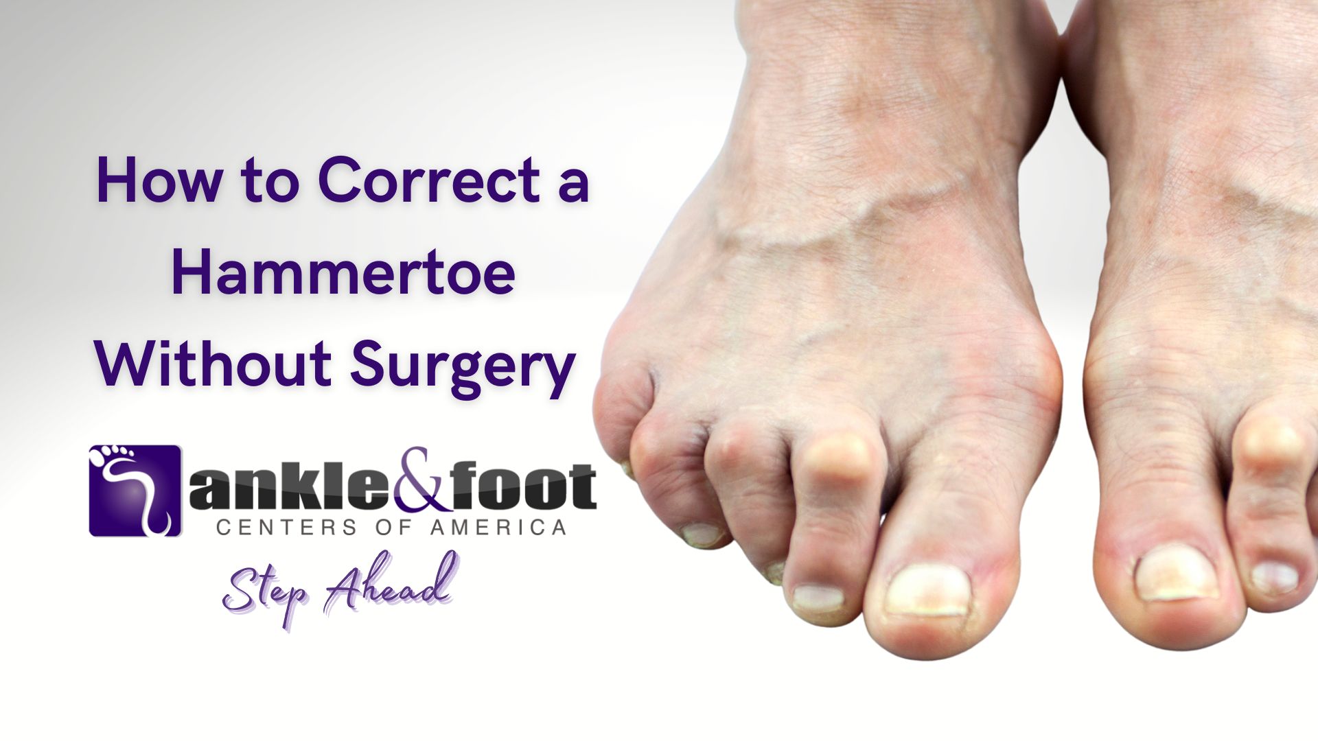 How To Correct a Hammertoe Without Surgery
