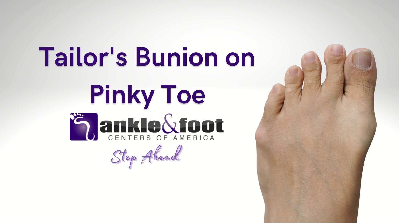 Tailor’s Bunion on Pinky Toe – Bunionette