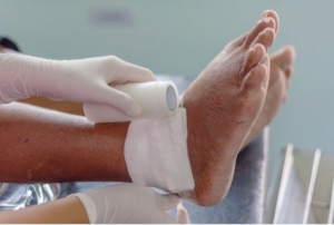 Treatment for Gout in Ankle