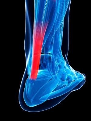 What Causes Achilles Tendonitis