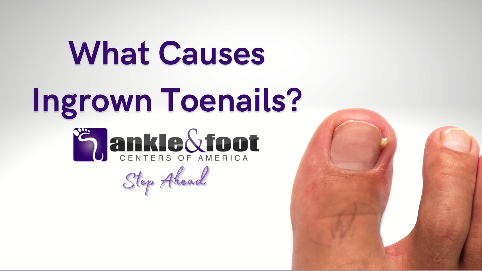Health Tips: Do you also have pain in your toenails? This treat...