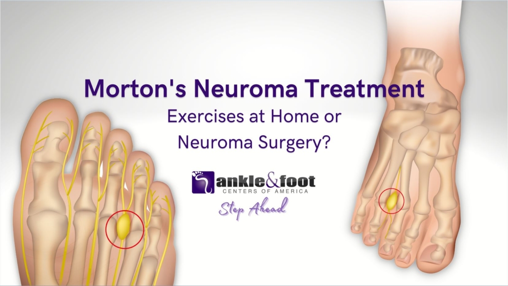 Morton’s Neuroma Treatment – Exercises at Home or Surgery?