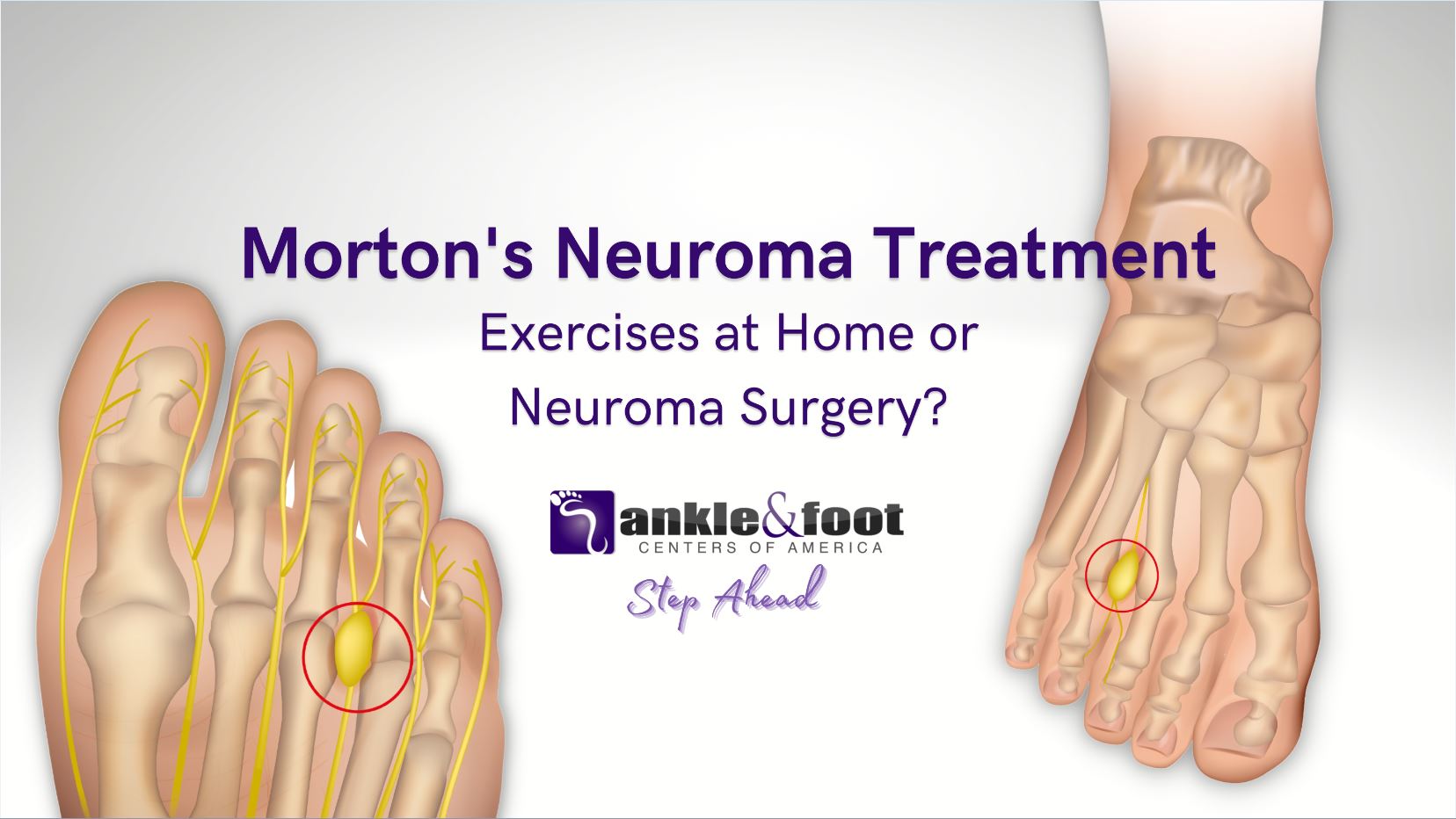 Morton’s Neuroma Treatment – Exercises at Home or Neuroma Surgery?
