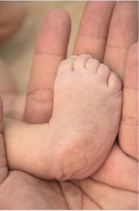 What Is Clubfoot