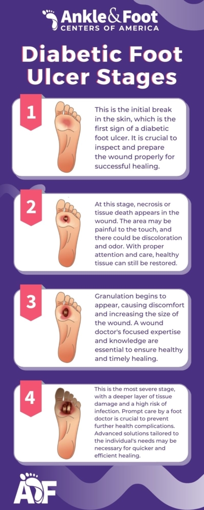 Diabetic Foot Ulcer Stages