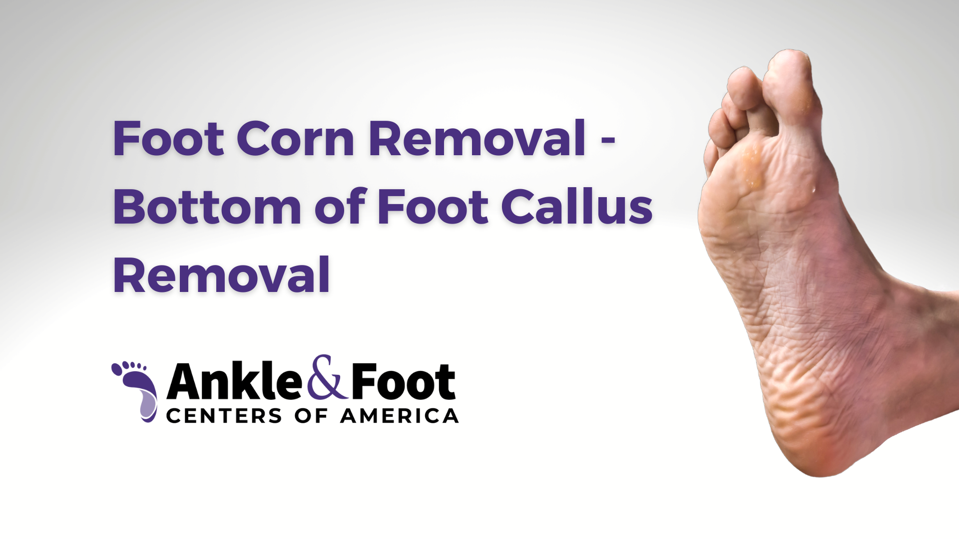 Foot Corn Removal – Bottom of Foot Callus Removal