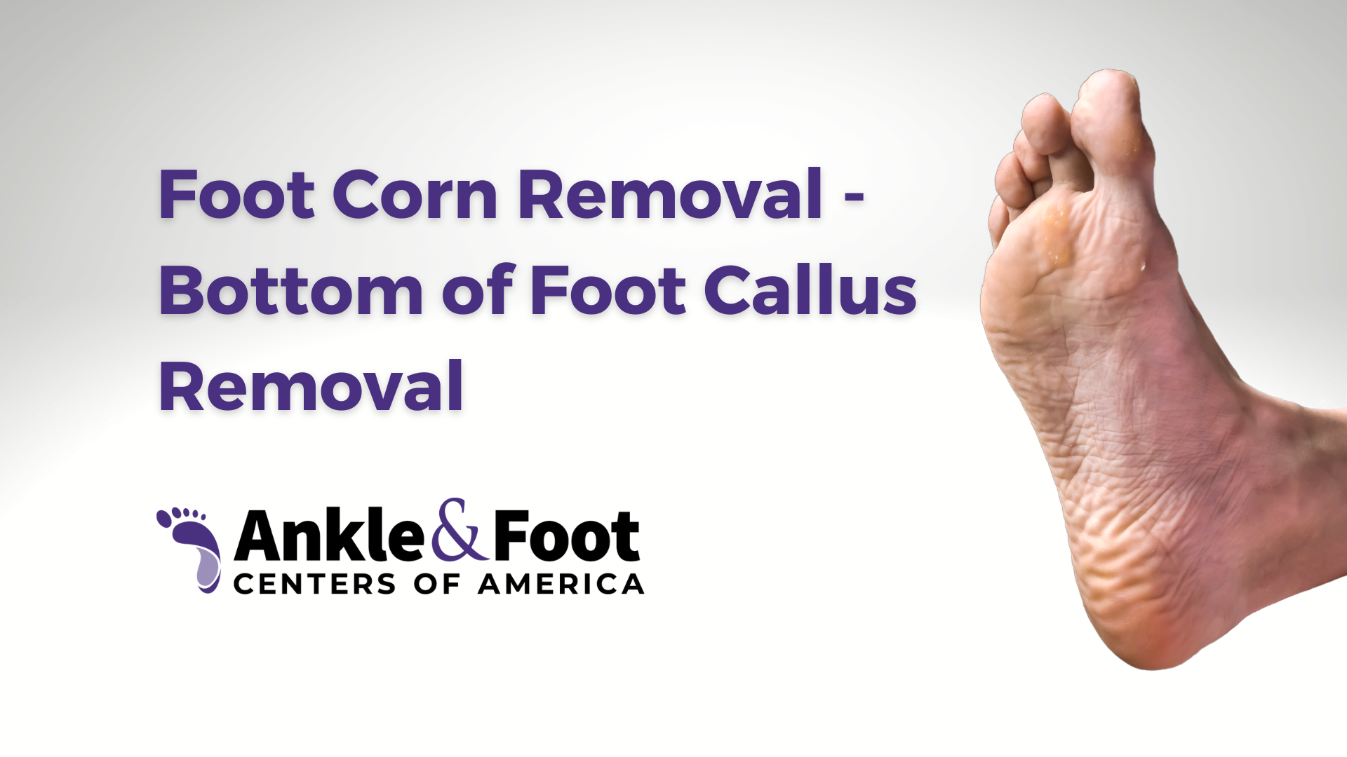 Treatment for foot store callus removal