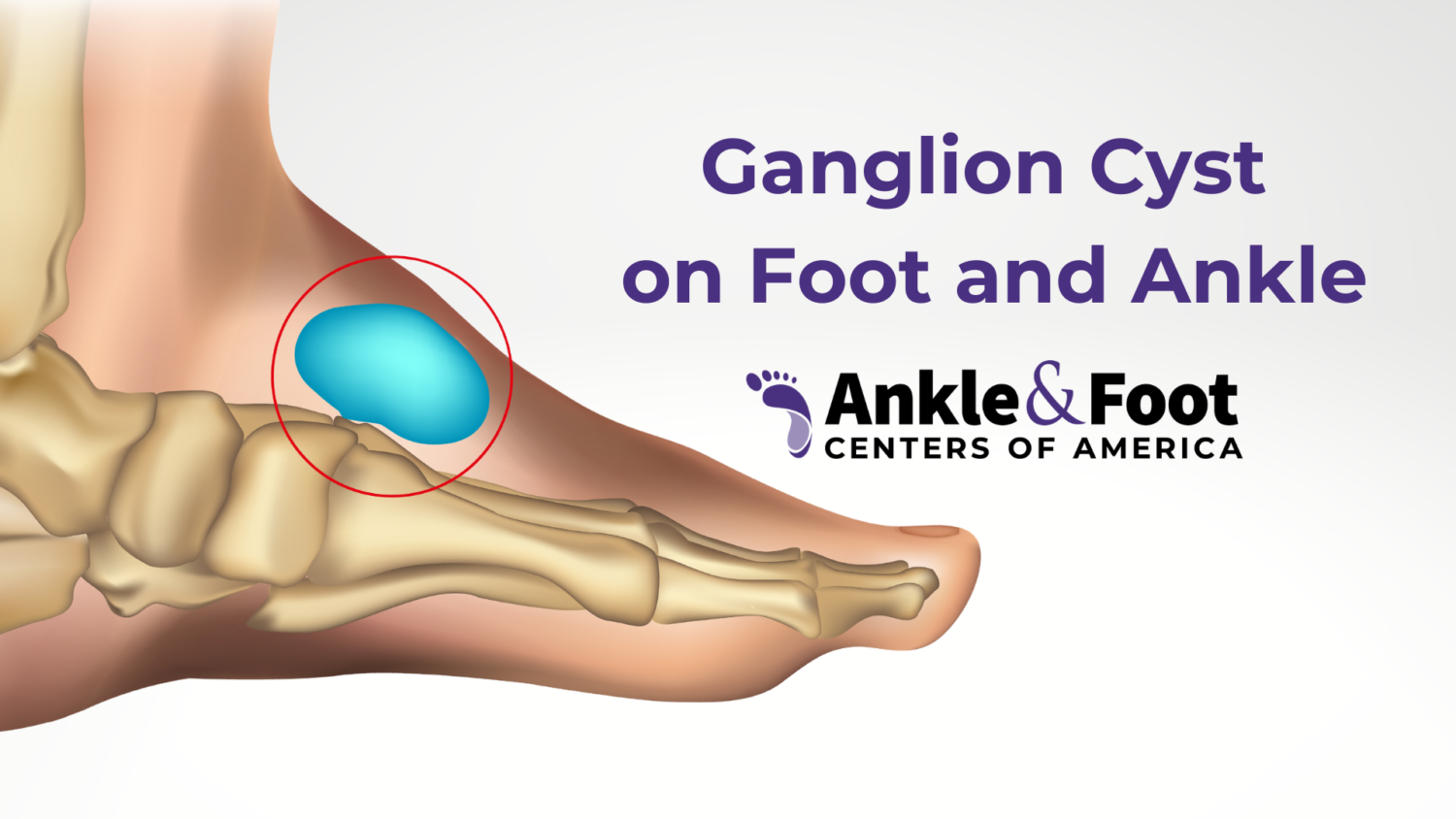 What Is A Ganglion Cyst On Foot And Ankle Cyst On 