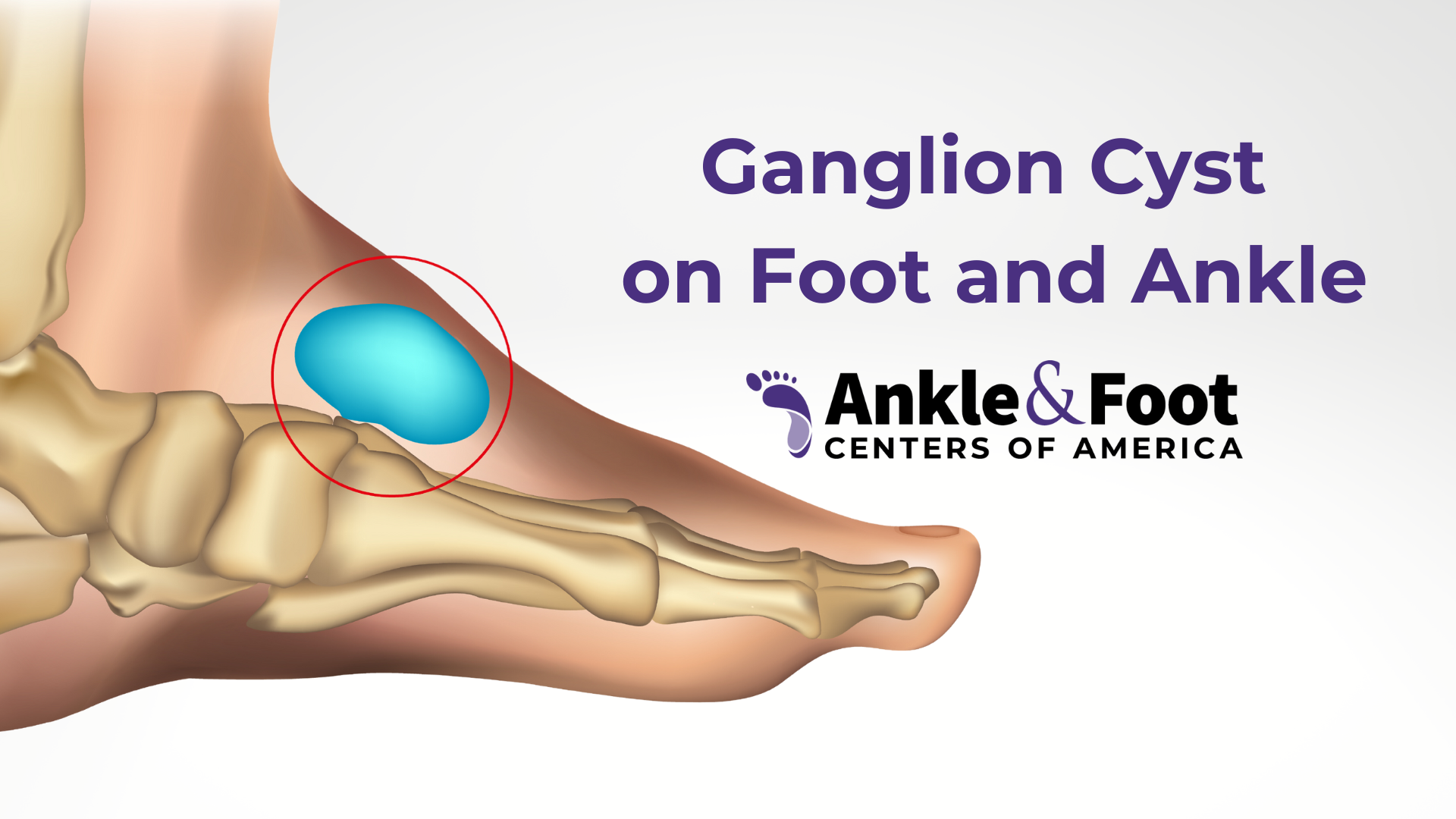 What is a Ganglion Cyst on Foot and Ankle?