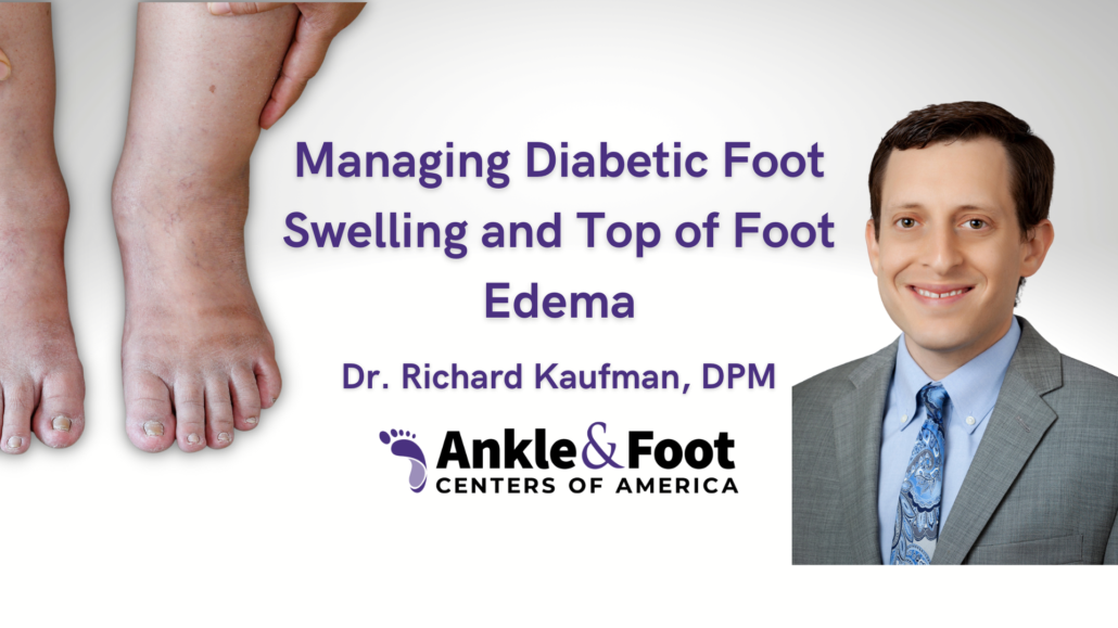 Diabetes Swollen Feet - Top of Foot Edema | Foot Swelling