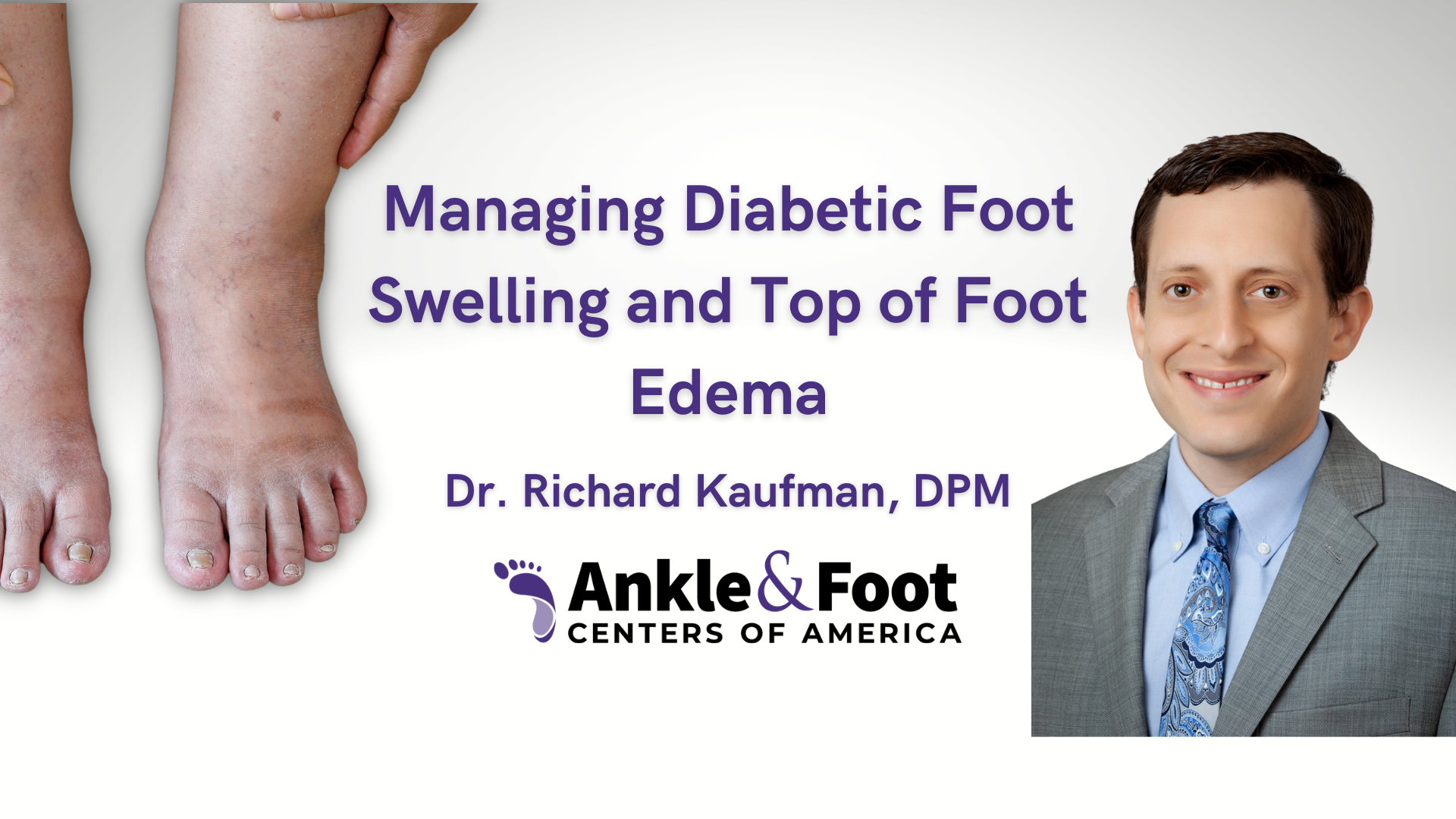 Managing Diabetic Foot Swelling and Top of Foot Edema