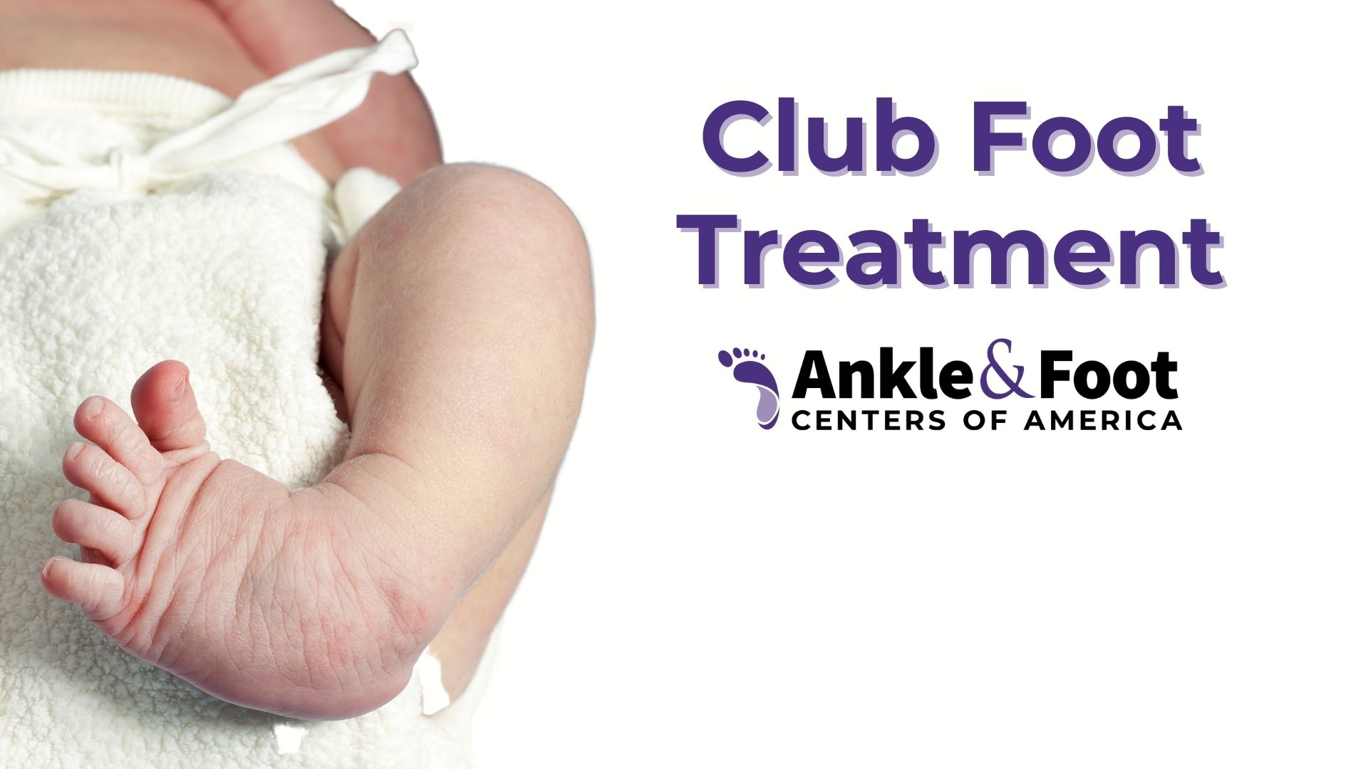 Club Foot Treatment