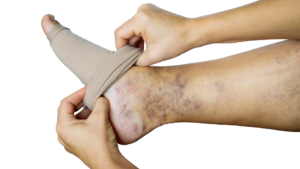 Compression Stockings Benefits