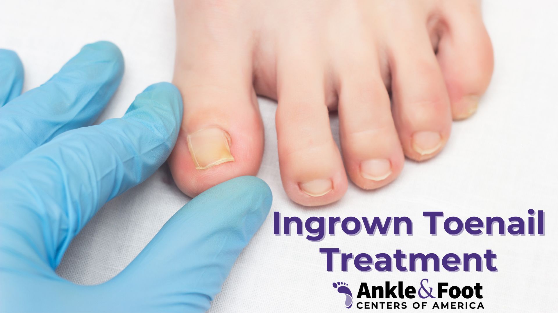 Ingrown Toenail Treatment  Ankle & Foot Centers of America