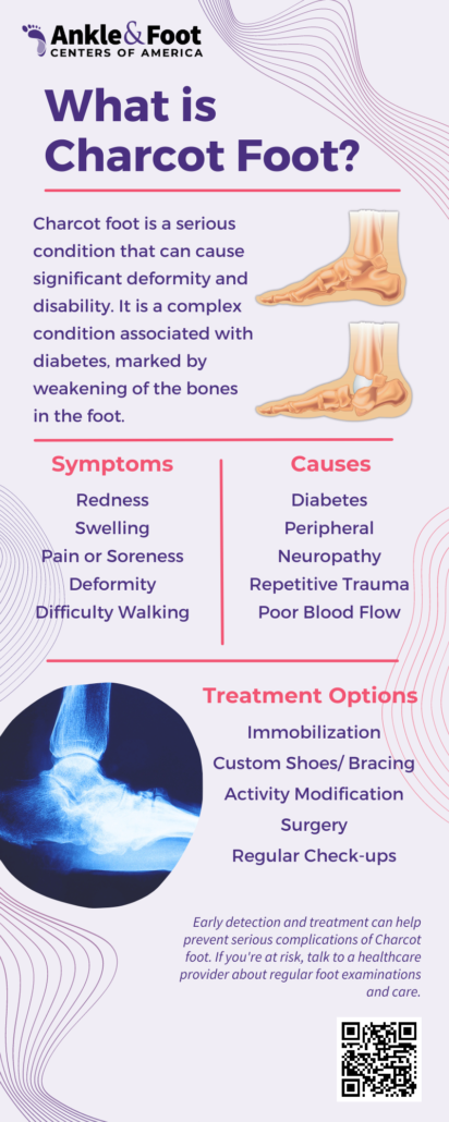 Charcot Foot Infographic