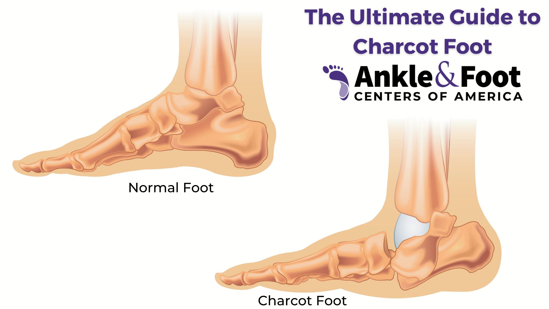 The Ultimate Guide to Charcot Foot