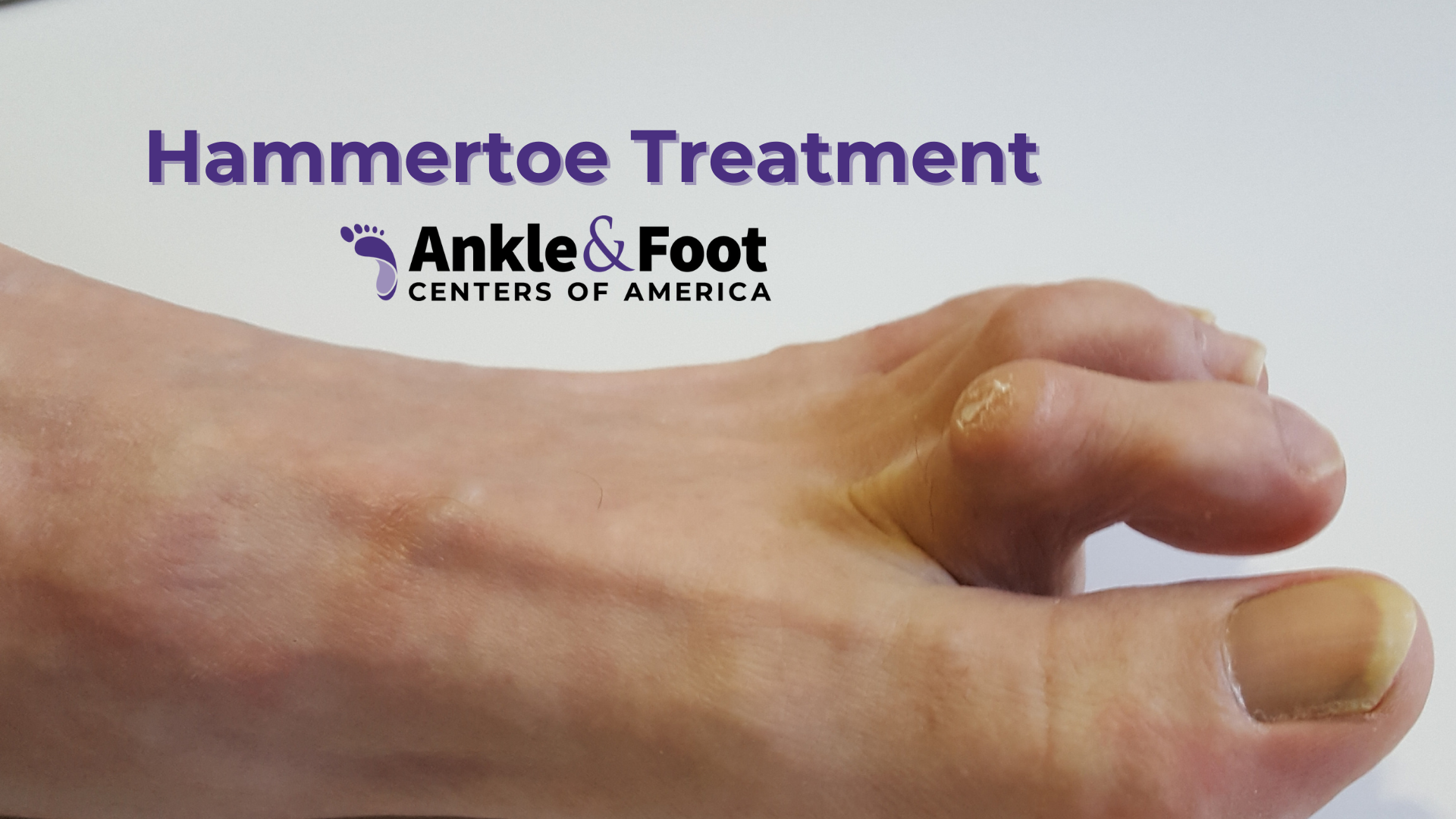 Hammer Toe Treatment
