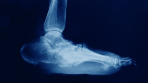 What is Charcot Foot