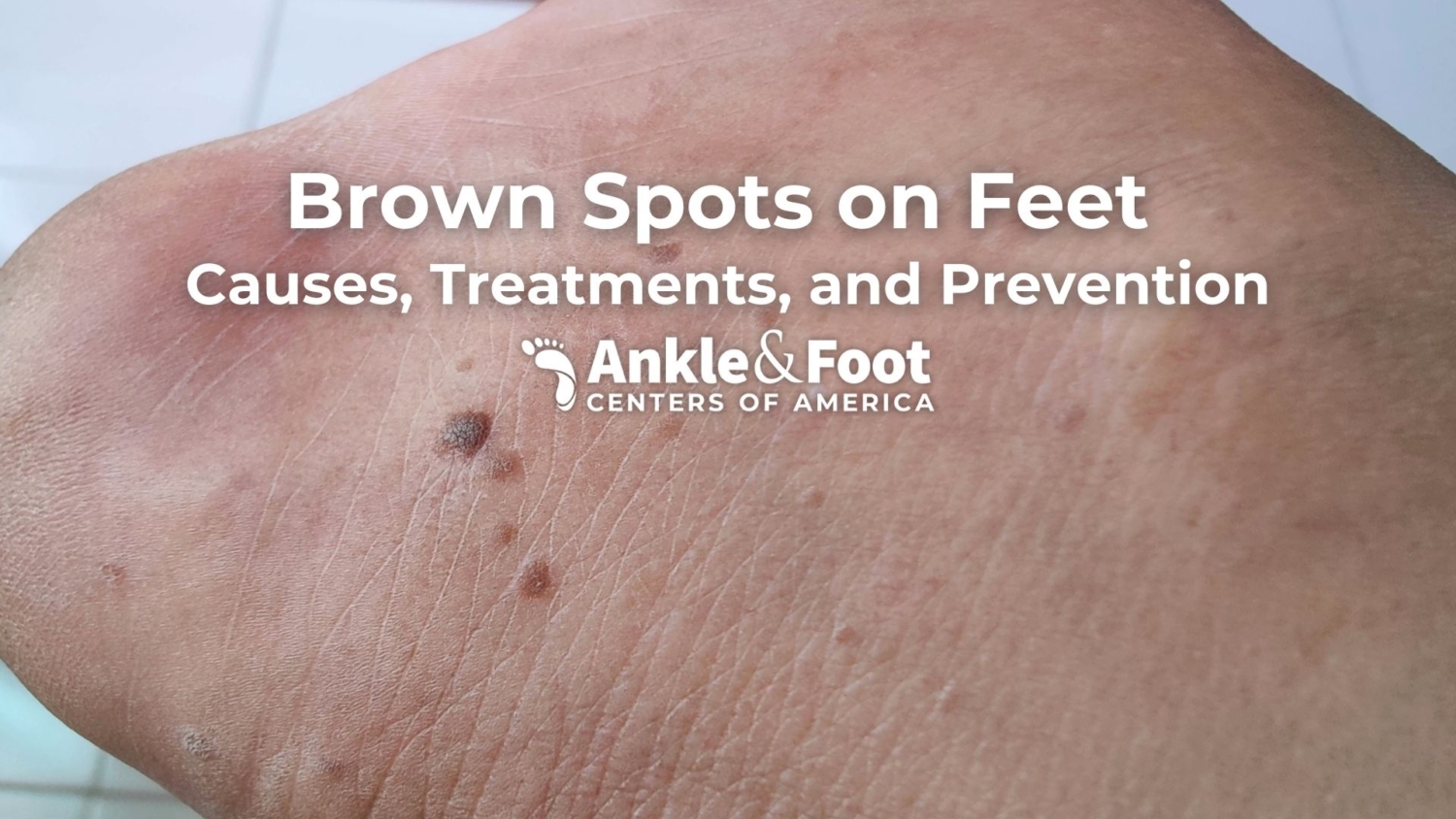 brown-spots-on-feet-causes-treatments-and-prevention