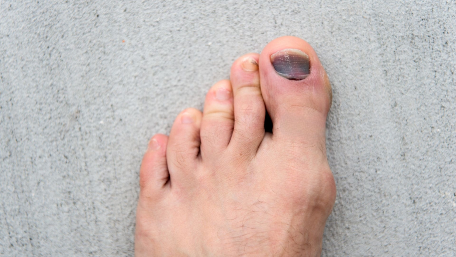 Purple Toenails: Causes, Treatments, and Prevention