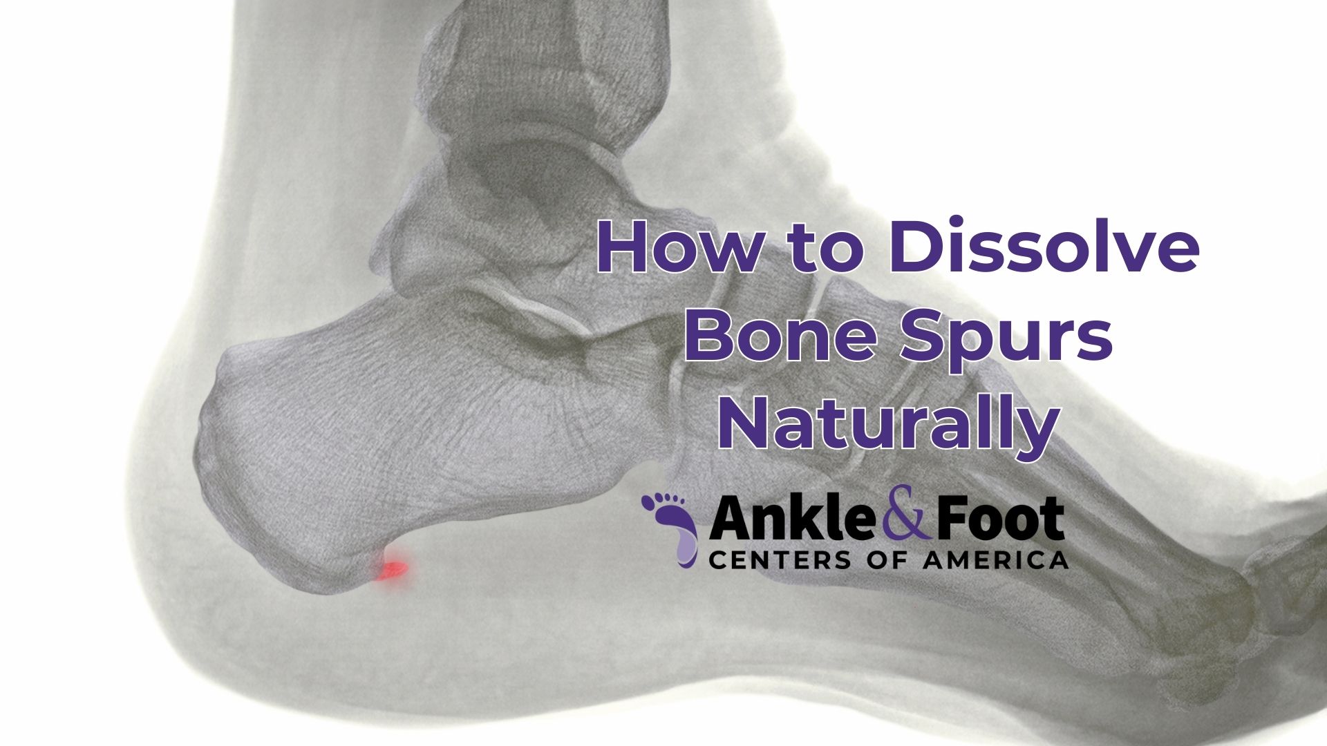 How to Dissolve Bone Spurs Naturally
