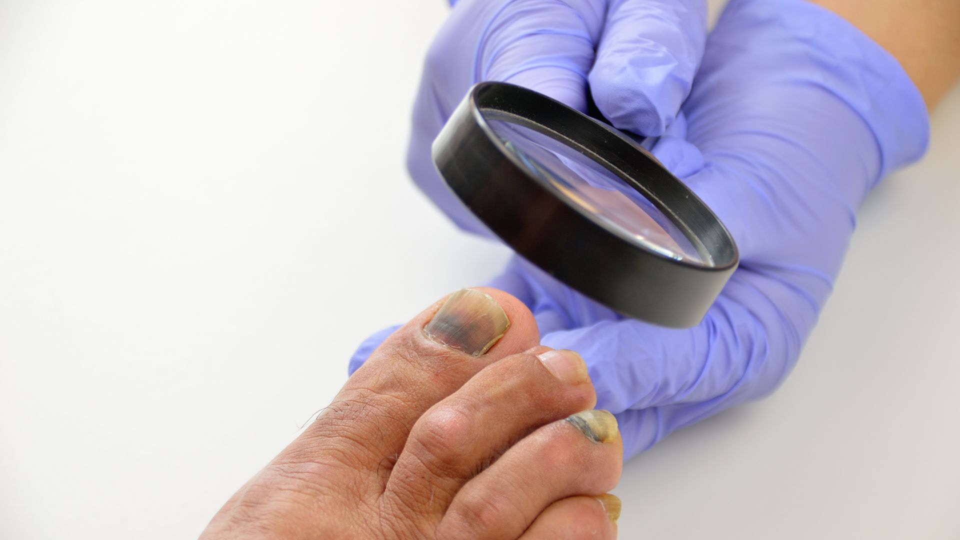 Purple Toenails: Causes, Treatments, and Prevention