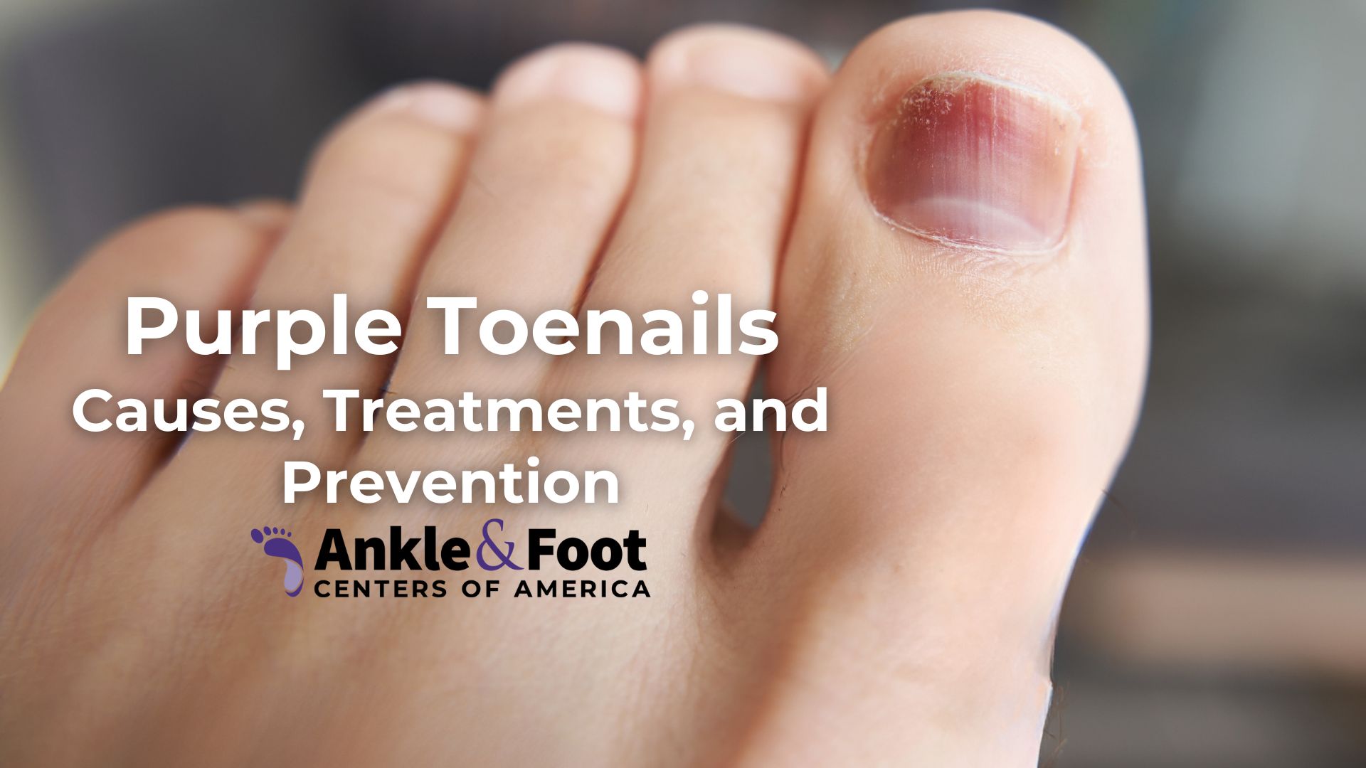 Purple Toenails: Causes, Treatments, and Prevention