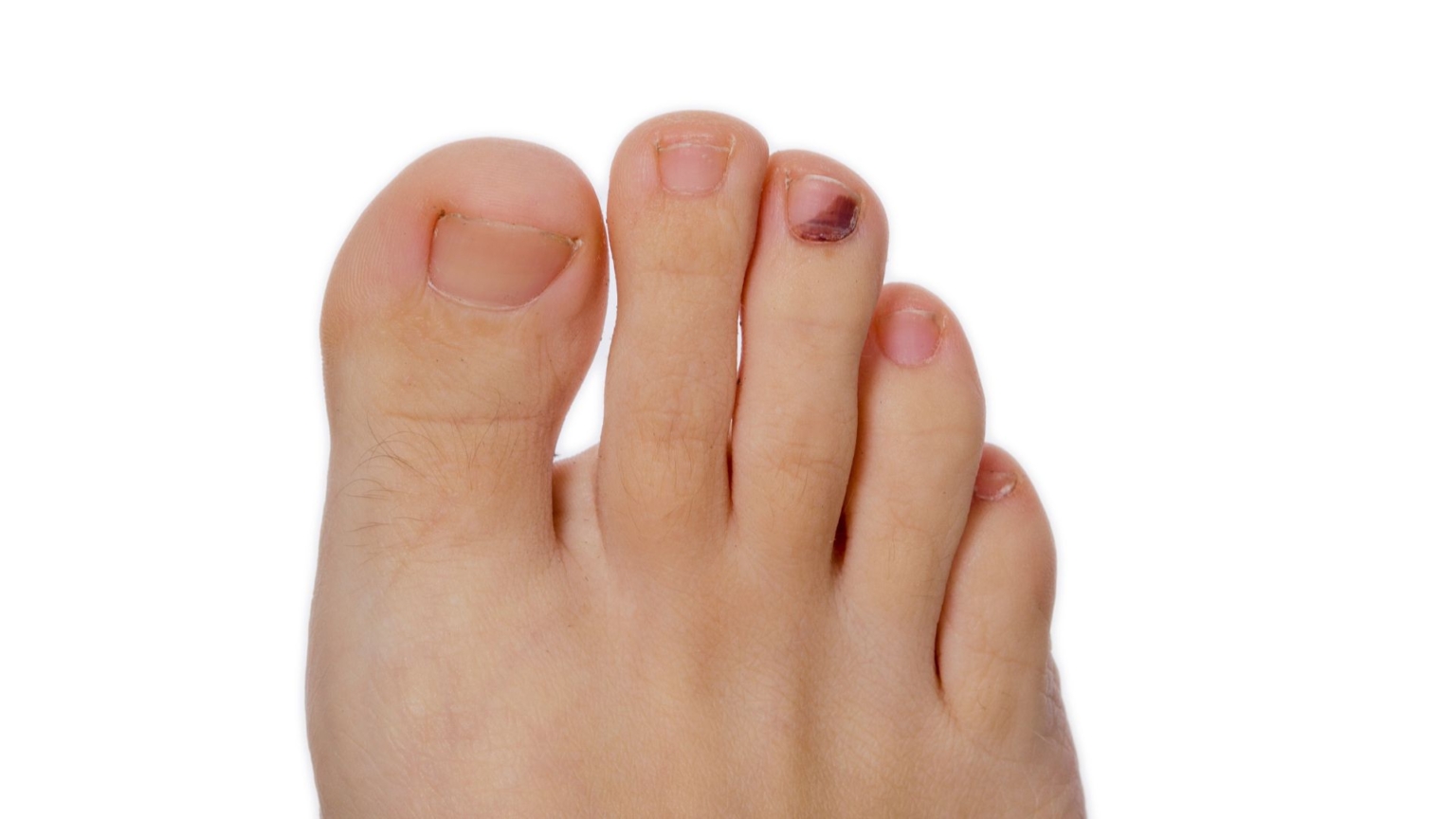 Purple Toenails Causes Treatments and Prevention