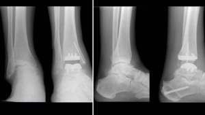 Ankle Arthroplasty