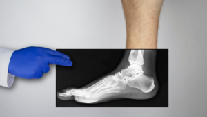 Foot Pain Metatarsal