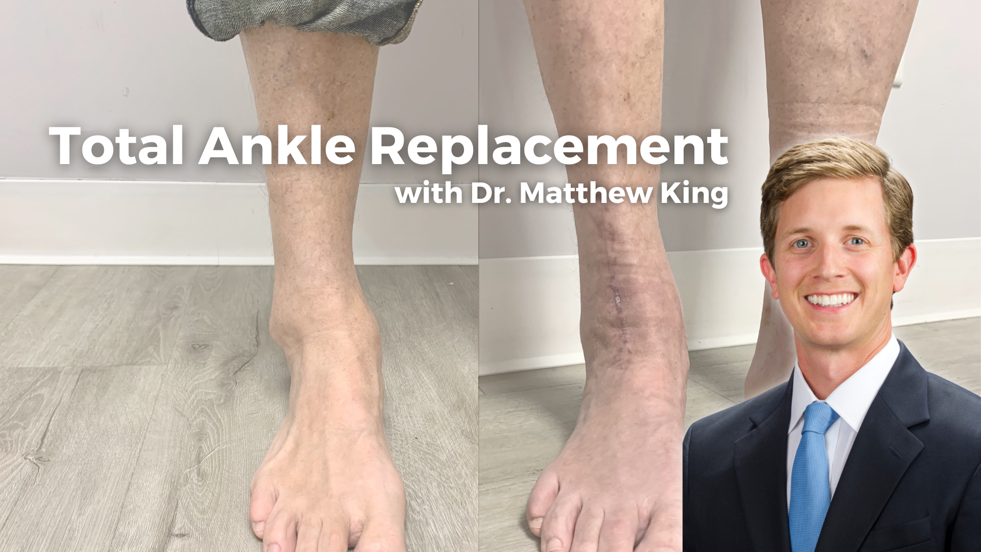 Total Ankle Replacement: Expertise & Success with Podiatrists