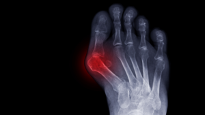 Arthritis in Big Toe Joint