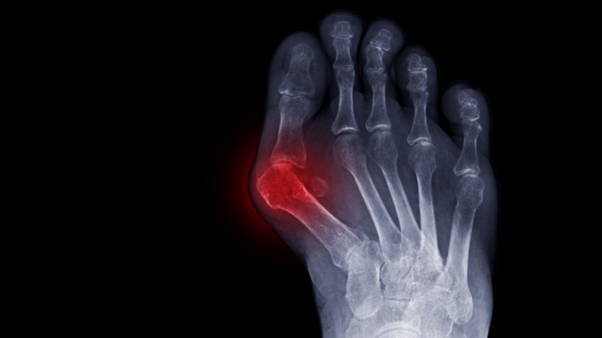 Big Toe Arthritis: Advanced Care & Treatment Strategies