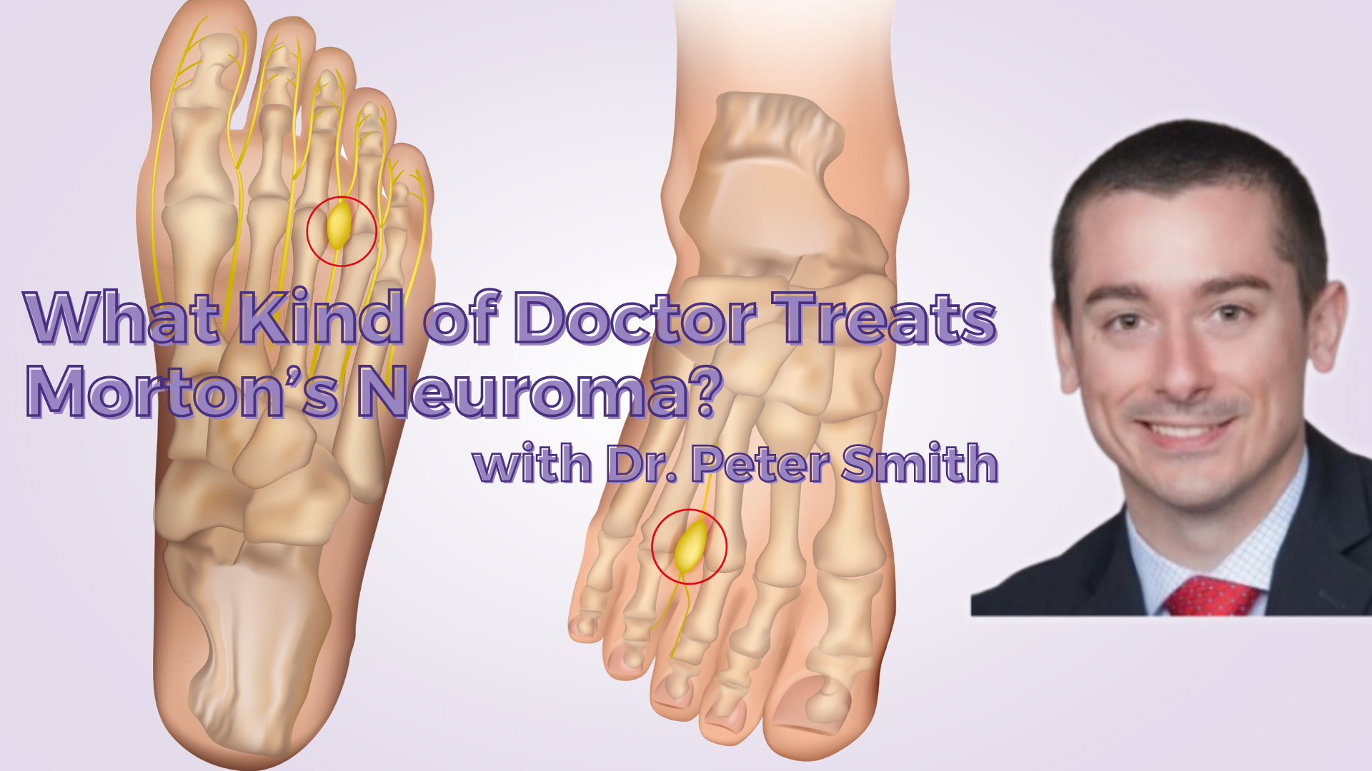 What Kind of Doctor Treats Mortons Neuroma