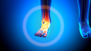 Ankle Arthritis Treatment in Roswell