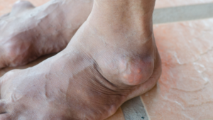 Ankle Gout Treatment in Atlanta