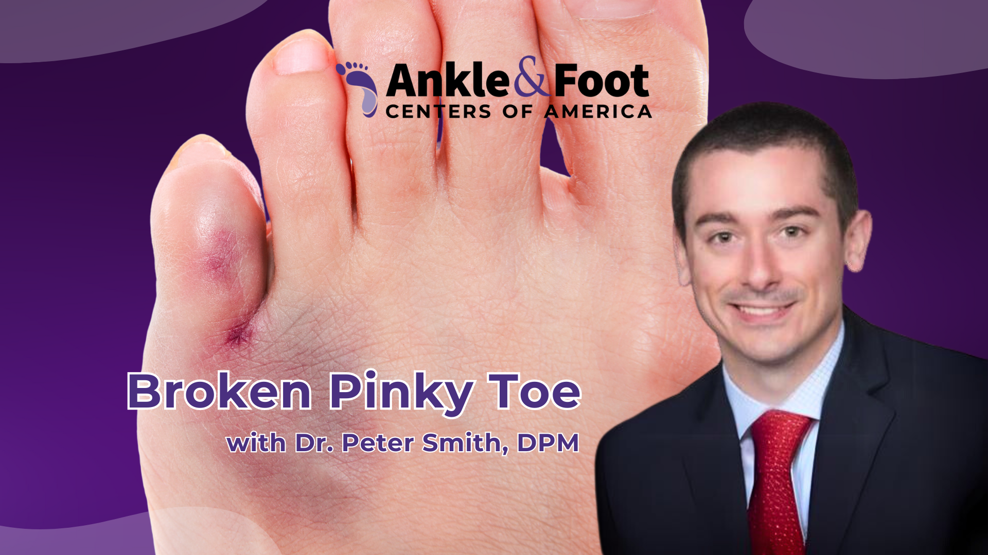 Broken Pinky Toe