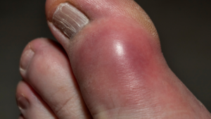 Foot Gout Treatment Atlanta