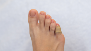 Little Toe Fracture