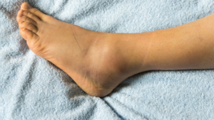 Roswell Foot Arthritis Treatment
