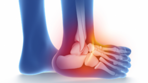 Sprained Ankle Treatment in Loganville